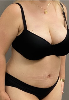 Tummy Tuck After Photo by Keshav Magge, MD; Bethesda, MD - Case 45818