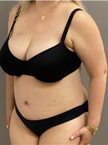 Tummy Tuck After Photo by Keshav Magge, MD; Bethesda, MD - Case 45818