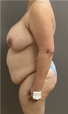 Tummy Tuck Before Photo by Keshav Magge, MD; Bethesda, MD - Case 45818