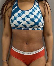 Tummy Tuck After Photo by Keshav Magge, MD; Bethesda, MD - Case 45820