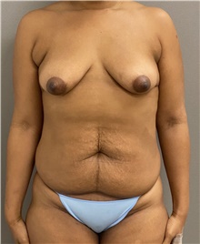 Tummy Tuck Before Photo by Keshav Magge, MD; Bethesda, MD - Case 45820