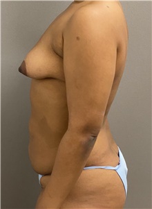 Tummy Tuck Before Photo by Keshav Magge, MD; Bethesda, MD - Case 45820