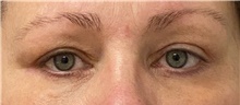Eyelid Surgery After Photo by Keshav Magge, MD; Bethesda, MD - Case 45821