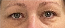 Eyelid Surgery Before Photo by Keshav Magge, MD; Bethesda, MD - Case 45821