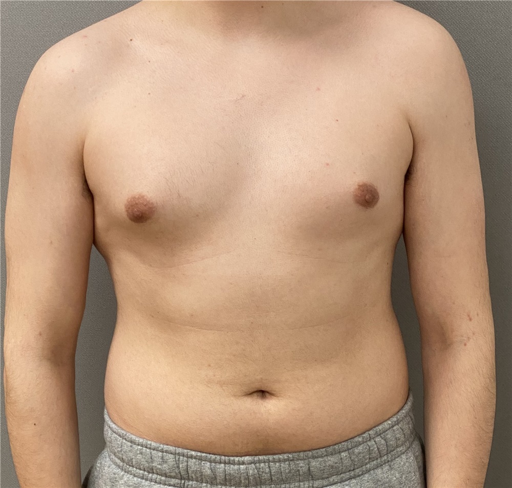 Breast Reduction Before and After Photos by Keshav Magge, MD