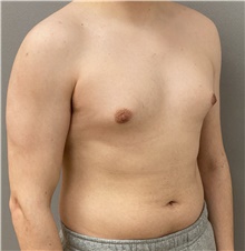 Male Breast Reduction Before Photo by Keshav Magge, MD; Bethesda, MD - Case 45825