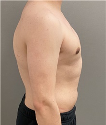 Male Breast Reduction After Photo by Keshav Magge, MD; Bethesda, MD - Case 45825