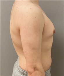 Male Breast Reduction Before Photo by Keshav Magge, MD; Bethesda, MD - Case 45825