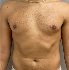 Male Breast Reduction After Photo by Keshav Magge, MD; Bethesda, MD - Case 45826