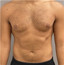 Male Breast Reduction Before Photo by Keshav Magge, MD; Bethesda, MD - Case 45826