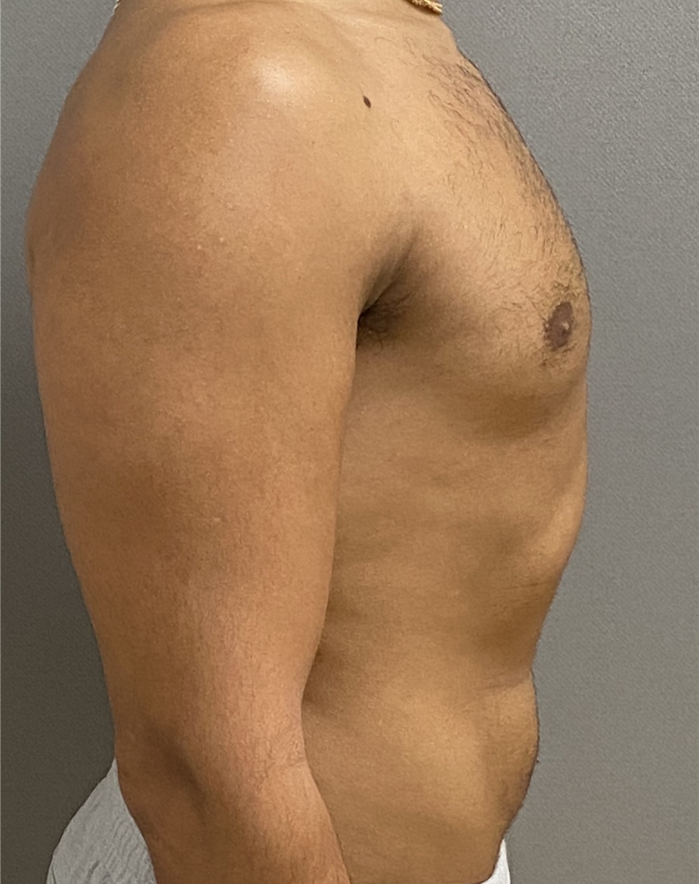 Breast Reduction Before and After Photos by Keshav Magge, MD; Bethesda, MD  - Case 47620