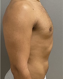 Male Breast Reduction After Photo by Keshav Magge, MD; Bethesda, MD - Case 45826