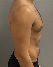 Male Breast Reduction Before Photo by Keshav Magge, MD; Bethesda, MD - Case 45826