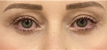 Eyelid Surgery After Photo by Keshav Magge, MD; Bethesda, MD - Case 45827