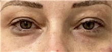 Eyelid Surgery Before Photo by Keshav Magge, MD; Bethesda, MD - Case 45827