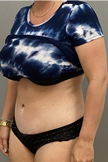 Tummy Tuck After Photo by Keshav Magge, MD; Bethesda, MD - Case 45828