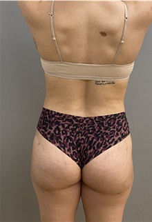 Buttock Lift with Augmentation After Photo by Keshav Magge, MD; Bethesda, MD - Case 45978