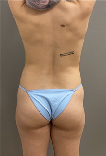 Buttock Lift with Augmentation Before Photo by Keshav Magge, MD; Bethesda, MD - Case 45978