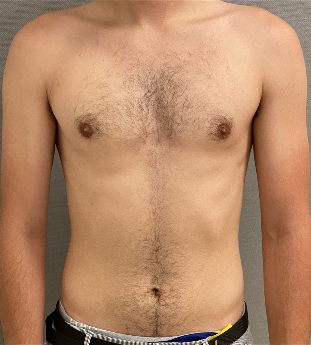 Male Breast Reduction Before and After Photos by Keshav Magge, MD; Bethesda,  MD - Case 45988
