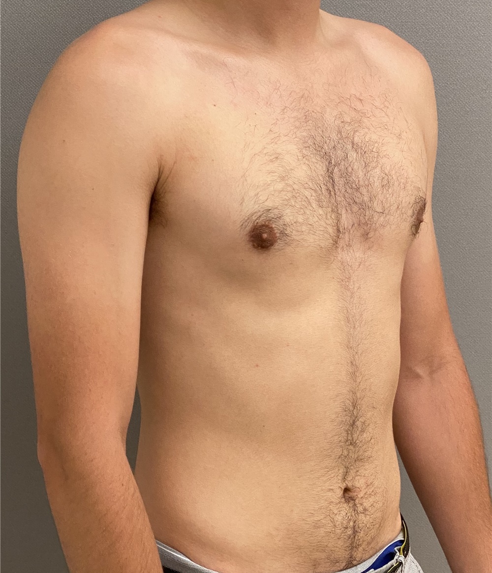 Male Breast Reduction Before and After Photos by Keshav Magge, MD; Bethesda,  MD - Case 45988