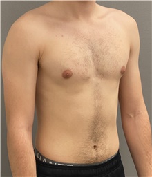 Male Breast Reduction Before Photo by Keshav Magge, MD; Bethesda, MD - Case 45988
