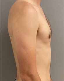Male Breast Reduction After Photo by Keshav Magge, MD; Bethesda, MD - Case 45988