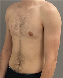 Male Breast Reduction Before Photo by Keshav Magge, MD; Bethesda, MD - Case 45988