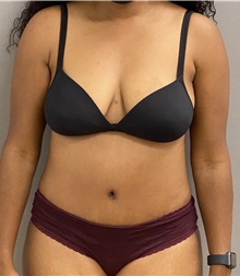 Tummy Tuck After Photo by Keshav Magge, MD; Bethesda, MD - Case 46012