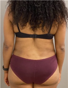 Tummy Tuck After Photo by Keshav Magge, MD; Bethesda, MD - Case 46012