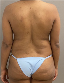 Tummy Tuck Before Photo by Keshav Magge, MD; Bethesda, MD - Case 46012