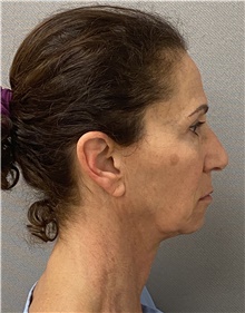 Facelift Before Photo by Keshav Magge, MD; Bethesda, MD - Case 46013