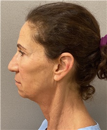 Facelift Before Photo by Keshav Magge, MD; Bethesda, MD - Case 46013