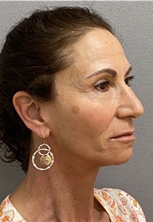 Neck Lift After Photo by Keshav Magge, MD; Bethesda, MD - Case 46014