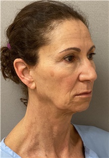 Neck Lift Before Photo by Keshav Magge, MD; Bethesda, MD - Case 46014