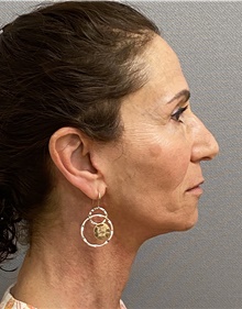 Neck Lift After Photo by Keshav Magge, MD; Bethesda, MD - Case 46014