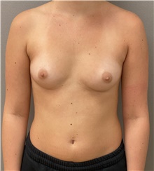 Breast Augmentation Before Photo by Keshav Magge, MD; Bethesda, MD - Case 46015