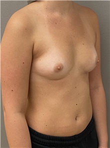 Breast Augmentation Before Photo by Keshav Magge, MD; Bethesda, MD - Case 46015