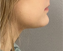 Chin Surgery After Photo by Keshav Magge, MD; Bethesda, MD - Case 46017