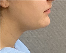 Chin Surgery Before Photo by Keshav Magge, MD; Bethesda, MD - Case 46017