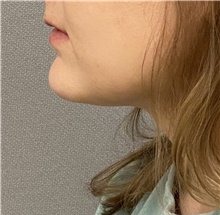 Chin Surgery After Photo by Keshav Magge, MD; Bethesda, MD - Case 46017