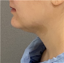 Chin Surgery Before Photo by Keshav Magge, MD; Bethesda, MD - Case 46017