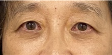 Eyelid Surgery After Photo by Keshav Magge, MD; Bethesda, MD - Case 46019