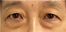 Eyelid Surgery Before Photo by Keshav Magge, MD; Bethesda, MD - Case 46019