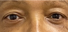 Eyelid Surgery After Photo by Keshav Magge, MD; Bethesda, MD - Case 46020