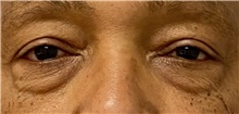 Eyelid Surgery Before Photo by Keshav Magge, MD; Bethesda, MD - Case 46020