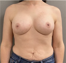 Breast Augmentation After Photo by Keshav Magge, MD; Bethesda, MD - Case 46022