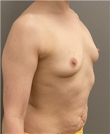 Breast Augmentation Before Photo by Keshav Magge, MD; Bethesda, MD - Case 46022