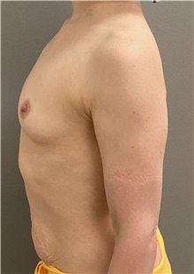 Breast Augmentation Before Photo by Keshav Magge, MD; Bethesda, MD - Case 46022