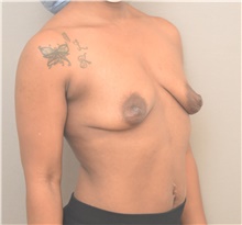Breast Lift Before Photo by Keshav Magge, MD; Bethesda, MD - Case 46023