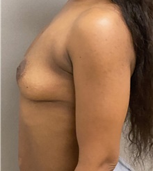 Breast Lift After Photo by Keshav Magge, MD; Bethesda, MD - Case 46023